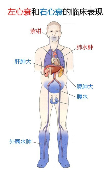 体循环淤血   消化道症状:腹胀,食欲不振,恶心,呕吐   劳力性呼吸困难