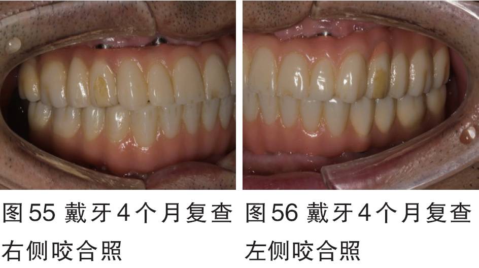 2016bitc银奖病例全口无牙颌种植固定修复一例