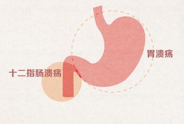 注意!一旦这四种胃溃疡的情况会癌变,必立刻就医