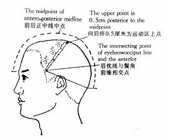 针灸知识丨头皮针操作笔记