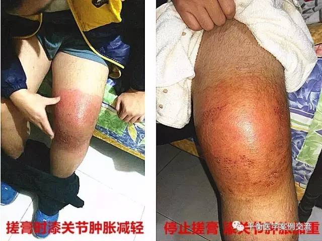 【佑三案例】膝关节软组织损伤伴中药外敷过敏感染