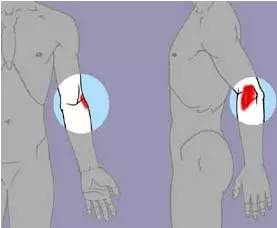 胳膊肘痛怎么办
