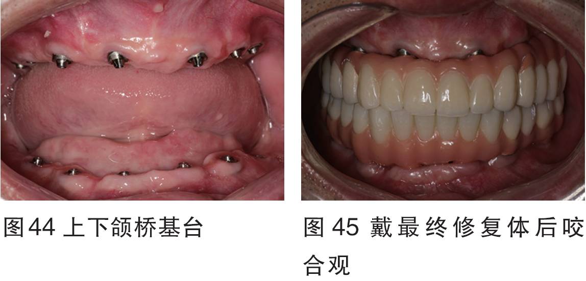 2016bitc银奖病例全口无牙颌种植固定修复一例