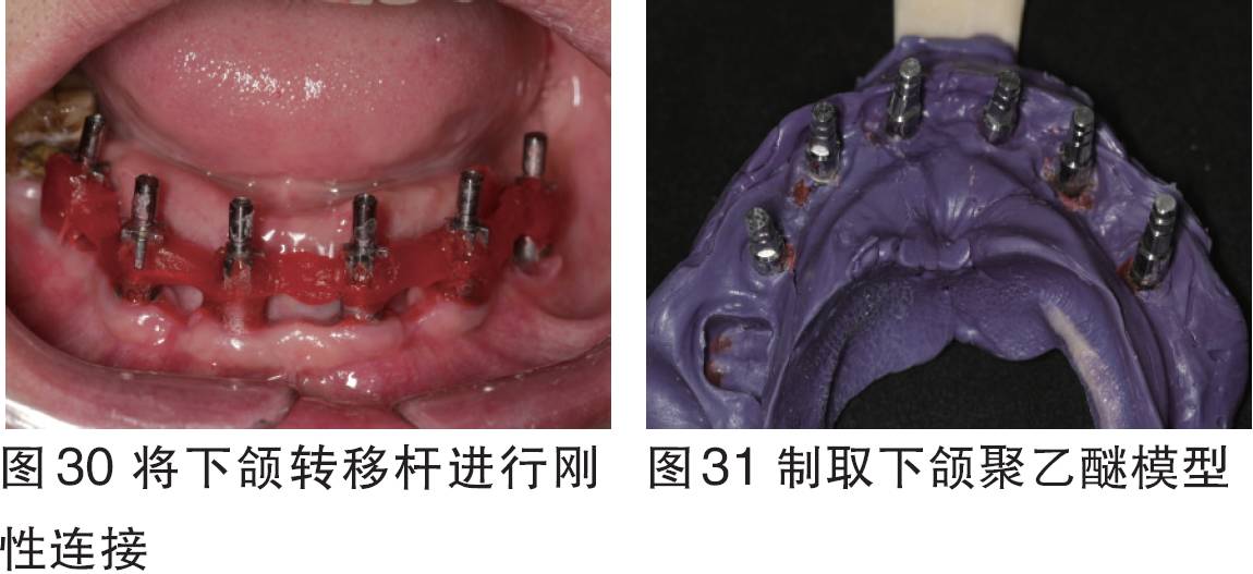 2016bitc银奖病例全口无牙颌种植固定修复一例