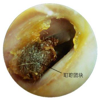 耳屎医学也叫耵聍,它是人体耵聍腺分泌的一种油性分泌物.