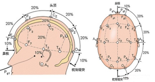 内侧深部的放电,普通脑电图难以监测到阳性结果,增加蝶骨电极脑电图