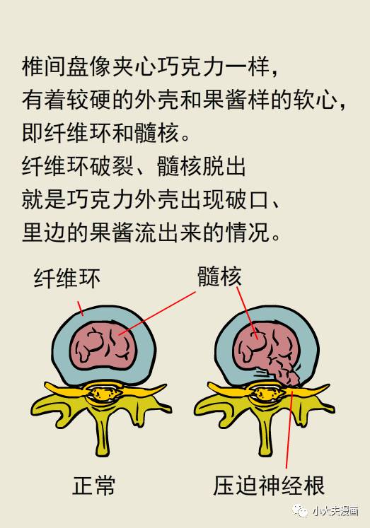 得了腰椎间盘突出不做手术能治好吗