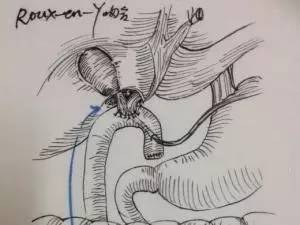 故手术中应尽量保证吻合口足够大,采取胆总管空肠roux-y吻合,空肠襻不