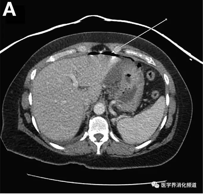 而下腹部ct扫描结果示:盆腔存在多个肿物(图b).