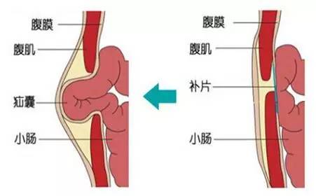 这种情形往往发生在原有疝气的小儿身上,可以在腹股沟的位置摸到异物