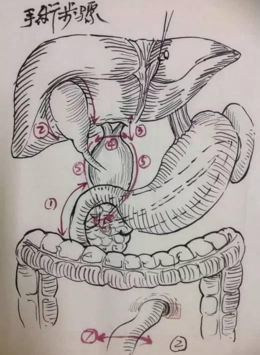 手术视频|腹腔镜胆总管囊肿切除术