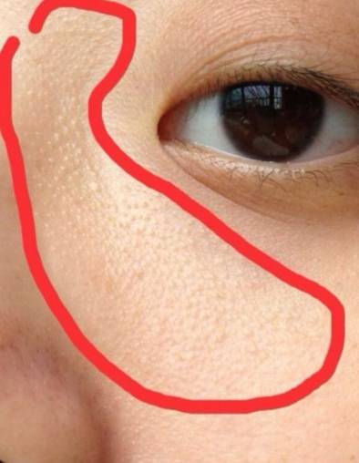 脸上长闭口粉刺的原因是什么?这些方法去粉刺效果佳