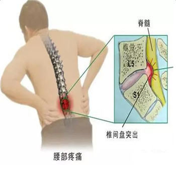 腰间盘突出应该怎么办