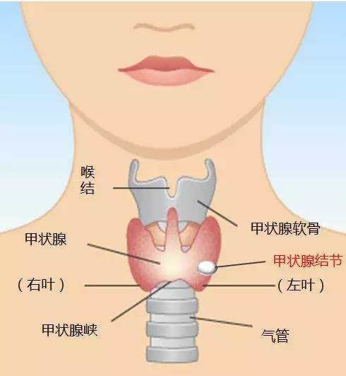 患者:医生摸到我颈部前方甲状腺内有个结节,会癌变吗?