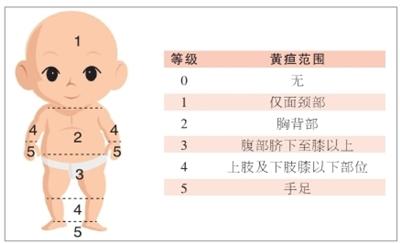 2,生理性黄疸