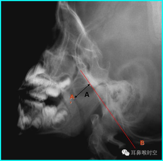 深度解析丨儿童腺样体肥大影像表现及诊断标准