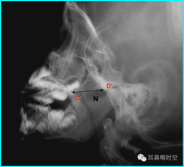 深度解析丨儿童腺样体肥大影像表现及诊断标准