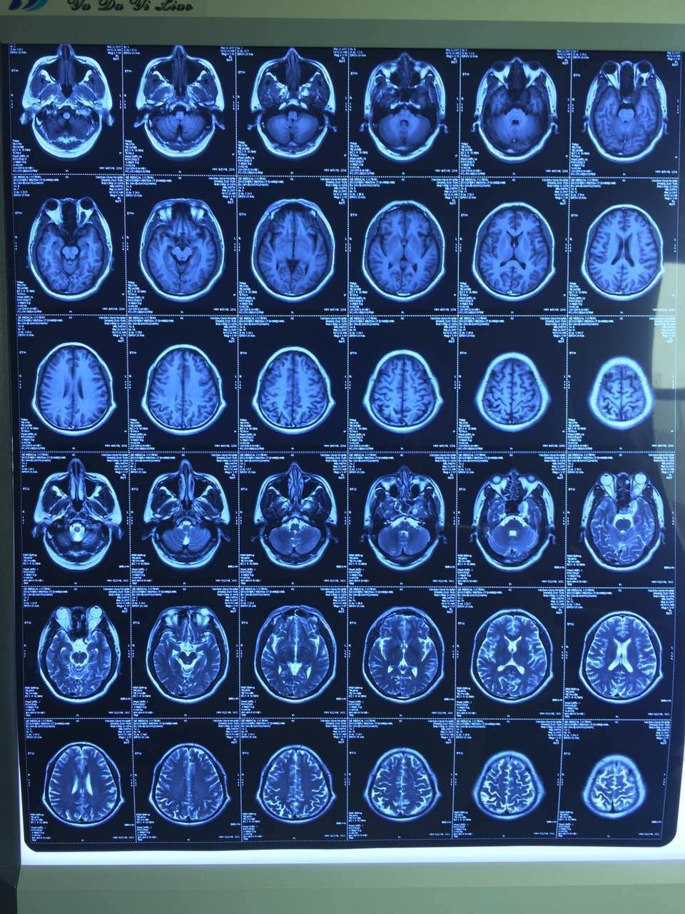 微创时代 历时9个小时,脑科中心顺利完成一例颅眶沟通肿瘤切除术