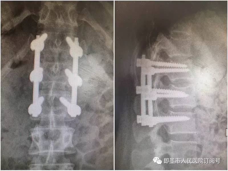 微创快讯:脊柱外科开展即墨市首例经皮椎弓根螺钉内固定手术