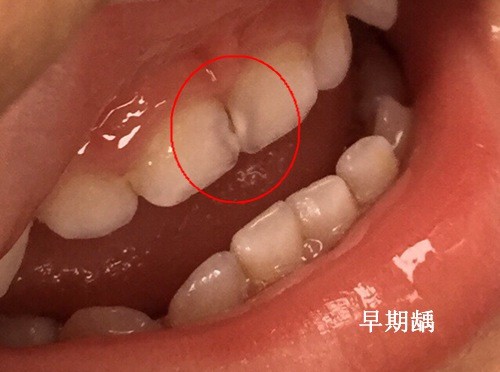 宝宝多大需要使用牙膏？被坑了的妈妈还真不少