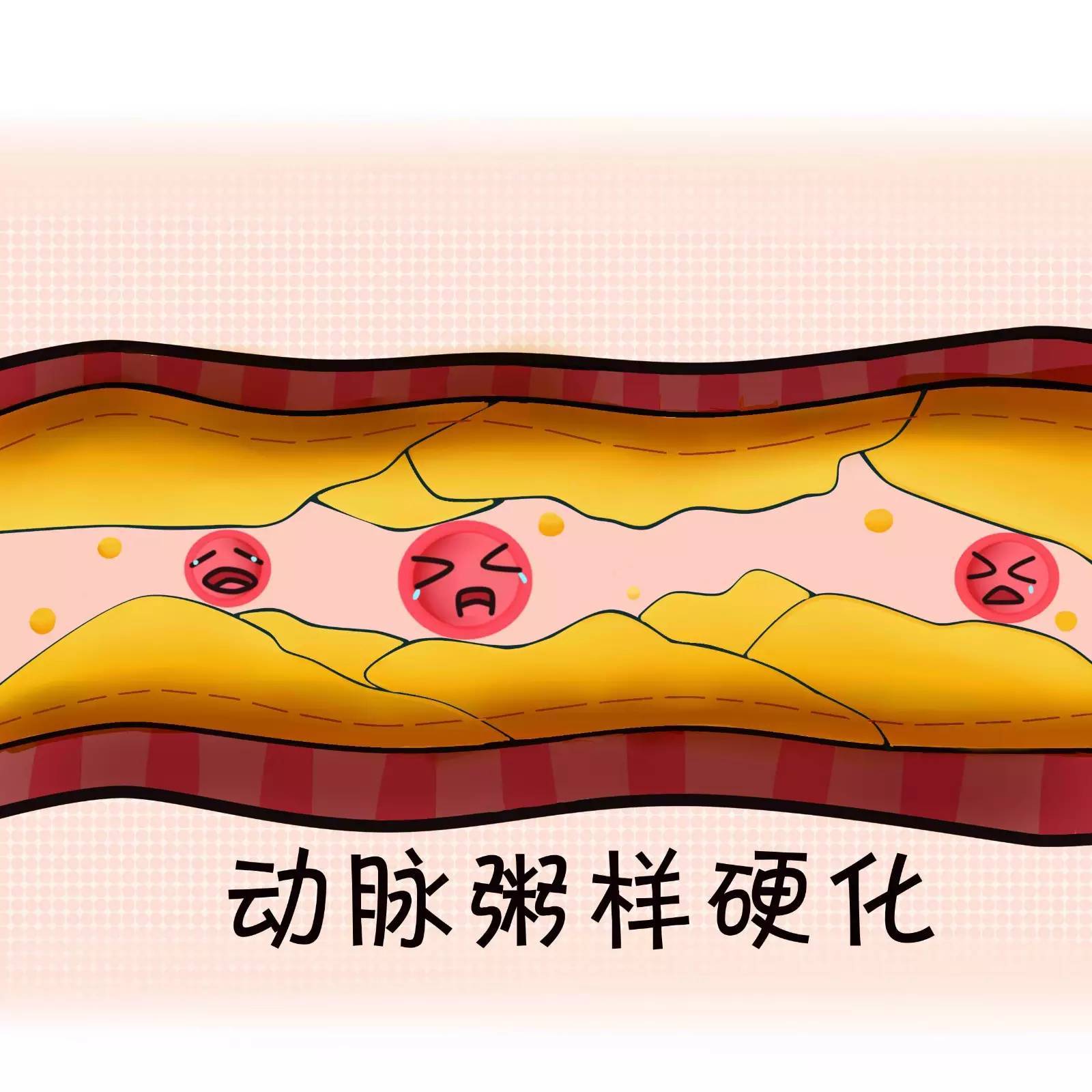 当附着在血管壁上的东东剥落后,则会形成血栓堵塞血管. ▼