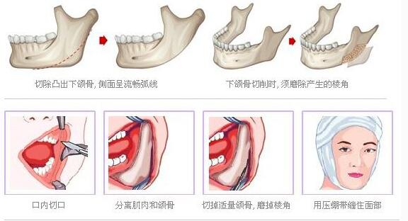 下颌角整形后多久化妆