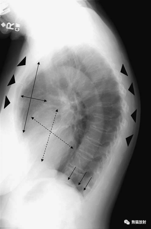 其它 正文  膈顶扁平(图a/b 箭); 胸廓前后径增宽,胸骨及胸椎曲度变圆