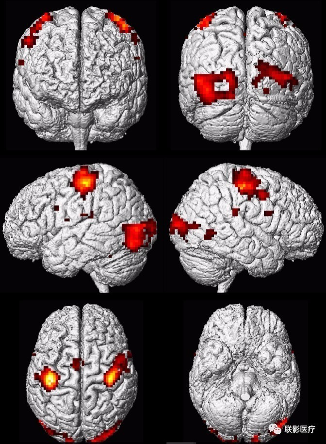 过去15年的大脑研究均有致命伤中国首个脑功能成像国标强势发布