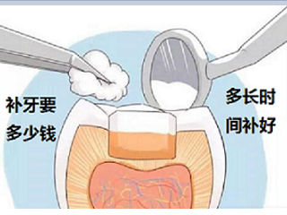 福州补牙多少钱一颗,补一次牙能用多长时间