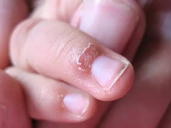 的指甲嵌入软组织内,成为嵌甲,损伤指甲周围的皮肤,造成化脓性感染