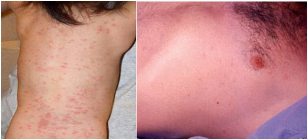 5,皮疹为稀疏不规则的红色斑丘疹,疹间皮肤正常,出疹顺序也有特点