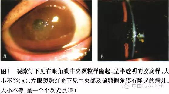 眼压:右眼tn,左眼tn;裂隙灯下见双眼结膜轻度充血,双眼角膜中央见大量