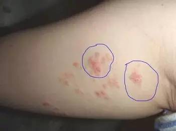 五,牛皮癣湿疹的症状也会开始是红点点,但是会很痒,有时候会渗水或者
