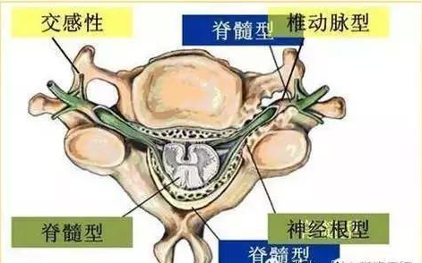 交感神经型颈椎病用什么方法治疗效果好?