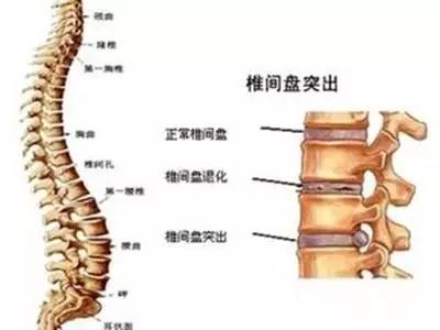 上图是我们的脊椎病变示意图.