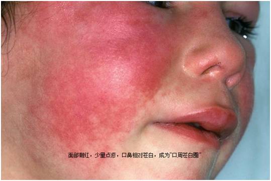可有少量点疹,口鼻周围相形之下显得苍白,称"口周苍白圈"猩红热草莓舌