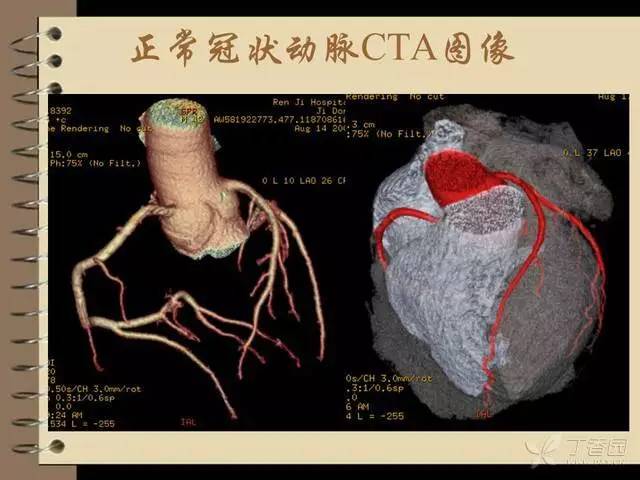 精彩幻灯:冠脉解剖与冠脉造影