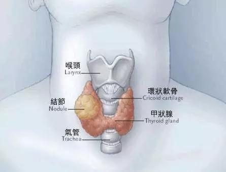 甲状腺癌特征就是有甲状腺结节的出现.