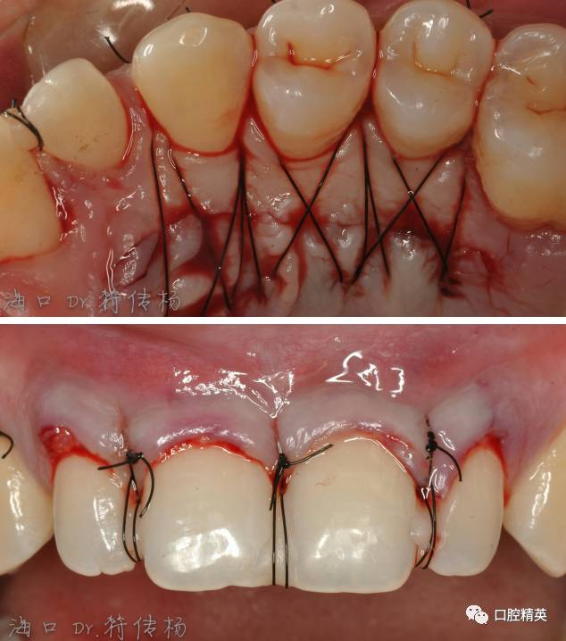 牙龈乳头重建病例