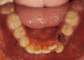 拥挤度大于7mm,高角型,侧切牙缺失,患者不反对,7条里占了4条 选择拔牙
