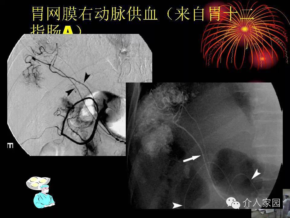 介入微课堂│各种各样的肝癌肝外供血动脉,你都见过吗