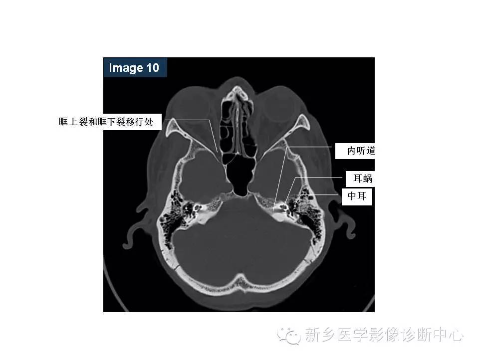 鼻咽部的详细解剖(含各个孔道)