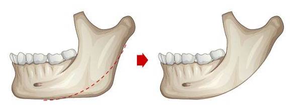 不过,这样宽大的下颌骨,是可以通过 下颌 磨骨或者截骨术来达到瘦脸