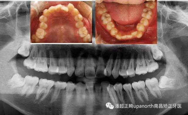 安氏Ⅱ类2分类 缺失下切牙案例分享