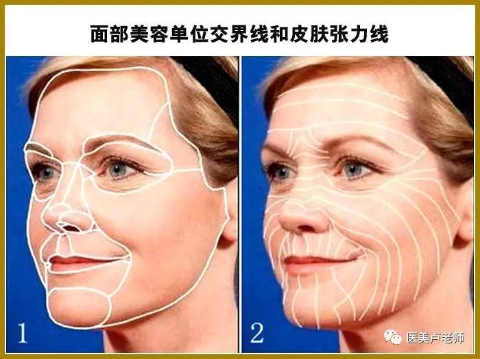 (三)方向:位于面部美容单位边界或顺皮纹方向的瘢痕不明显(见图1,图2)