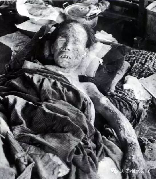 长崎遭受原子弹核辐射的日本老妇人,在遭受辐射伤害一周后死亡.