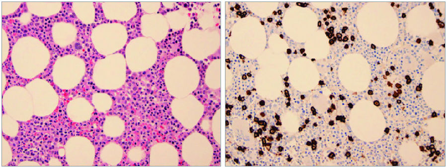 图左:骨髓活检 (he染色,放大倍数×400);图右:免疫组化检查(cd138免疫
