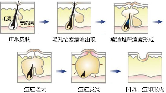 痘印形成的过程