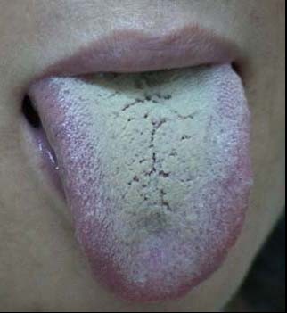 中医望诊 看舌苔知道患有哪些病症