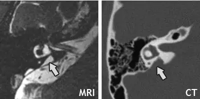 eva的确诊常用的两种检查手段包括:内耳mri(核磁共振成像)和内耳ct